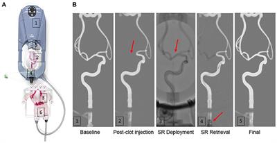 Modeling Large Vessel Occlusion Stroke for the Evaluation of Endovascular Therapy According to Thrombus Composition